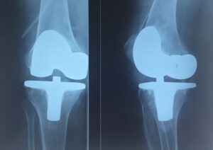 Arthroplasties