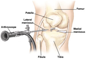 Arthroscopie